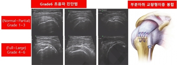 회전근개파열 수술비용 부담 초음파진단과 부분마취로 낮출 수 있어 세계일보